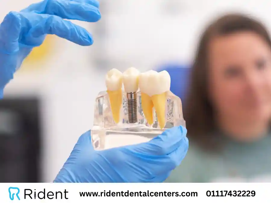 بدائل زراعة الأسنان وهل يفقد الناس أسنانهم بسبب داء السكري؟